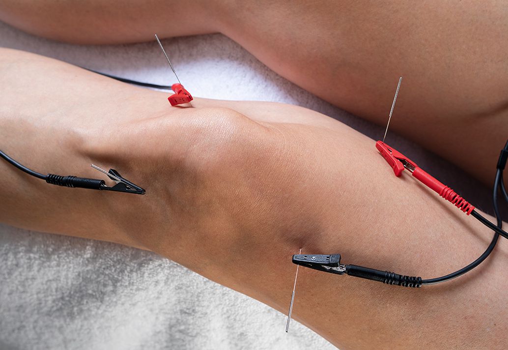 PENS: 'Electrical Dry Needling'